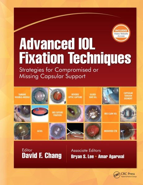 Advanced IOL Fixation Techniques (eBook, ePUB)