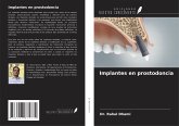 Implantes en prostodoncia