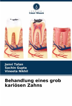 Behandlung eines grob kariösen Zahns - Talan, Janvi;Gupta, Sachin;Nikhil, Vineeta