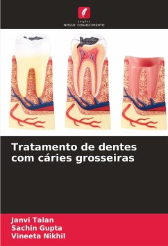 Tratamento de dentes com cáries grosseiras - Talan, Janvi;Gupta, Sachin;Nikhil, Vineeta