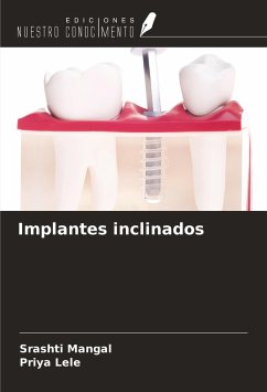 Implantes inclinados - Mangal, Srashti; Lele, Priya