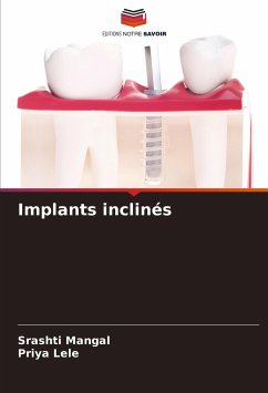Implants inclinés - Mangal, Srashti;Lele, Priya