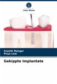 Gekippte Implantate