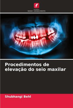 Procedimentos de elevação do seio maxilar - Behl, Shubhangi