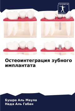 Cover Osteointegraciq zubnogo implantata