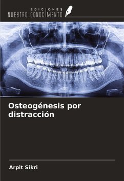 Cover Osteogénesis por distracción