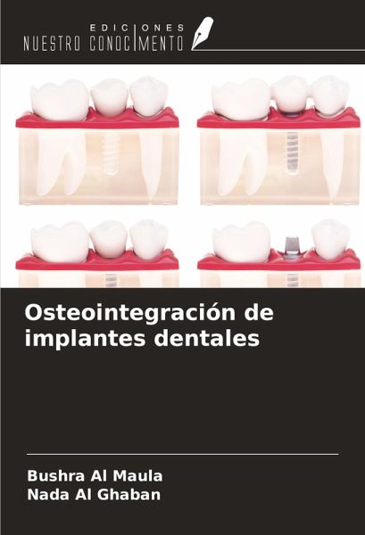 Osteointegración de implantes dentales Osteointegración de implantes dentales