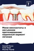 Mini-implantaty w nes#emnom protezirowanii: nadezhnyj wariant lecheniq Mini-implantaty w nes#emnom protezirowanii: nadezhnyj wariant lecheniq