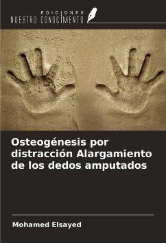Cover Osteogénesis por distracción Alargamiento de los dedos amputados