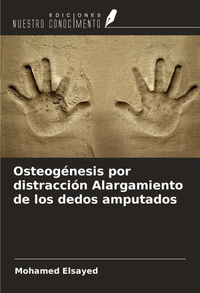 Osteogénesis por distracción Alargamiento de los dedos amputados