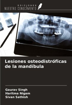 Lesiones osteodistróficas de la mandíbula - Singh, Gaurav; Nigam, Haritma; Sathish, Sivan