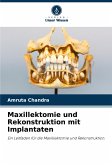 Maxillektomie und Rekonstruktion mit Implantaten Maxillektomie und Rekonstruktion mit Implantaten