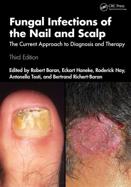 Fungal Infections of the Nail and Scalp (eBook, ePUB)