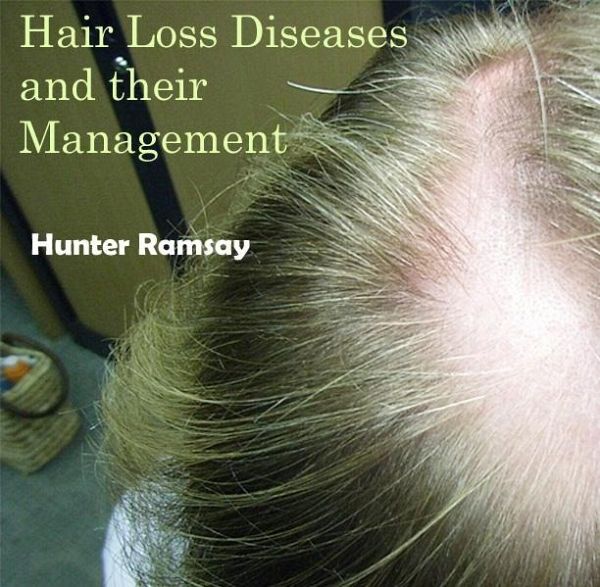 Hair Loss Diseases and their Management (eBook, PDF) Hair Loss Diseases and their Management (eBook, PDF)