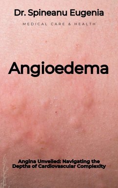 Angioedema Unveiled: A Comprehensive Exploration of Mechanisms, Management, and Future Frontiers (eBook, ePUB) - Eugenia, Spineanu