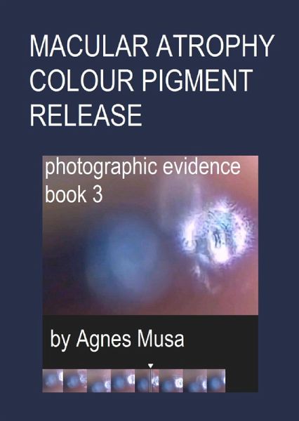 Macular Atrophy Colour Pigment Release, Photographic Evidence Book 3 (Macular Degeneration Atrophy, Photographic Evidence Series of Books, #14) (eBook, ePUB)