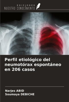 Perfil etiológico del neumotórax espontáneo en 206 casos - Abid, Narjes; Debiche, Soumaya
