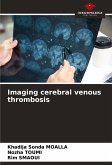 Imaging cerebral venous thrombosis Imaging cerebral venous thrombosis