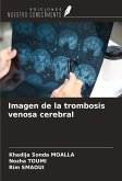 Imagen de la trombosis venosa cerebral