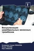 Vizualizaciq cerebral'nyh wenoznyh trombozow Vizualizaciq cerebral'nyh wenoznyh trombozow