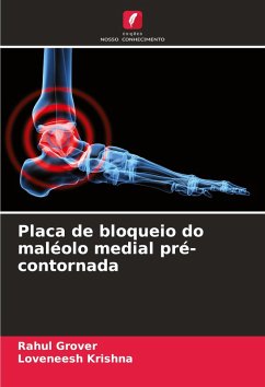 Cover Placa de bloqueio do maléolo medial pré-contornada