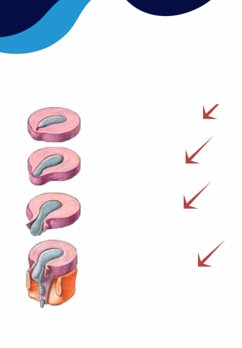 Cover Hernia Discal - Bônus 1 (eBook, PDF)