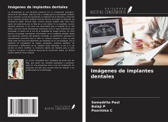 Cover Imágenes de implantes dentales