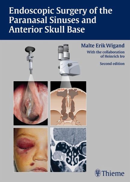 Endoscopic Surgery of the Paranasal Sinuses and Anterior Skull Base (eBook, ePUB) Endoscopic Surgery of the Paranasal Sinuses and Anterior Skull Base (eBook, ePUB)