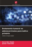 Brotamento tumoral no adenocarcinoma pancreático primário Brotamento tumoral no adenocarcinoma pancreático primário