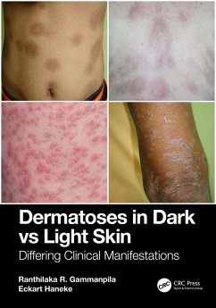 Cover Dermatoses in Dark Vs Light Skin (eBook, ePUB)