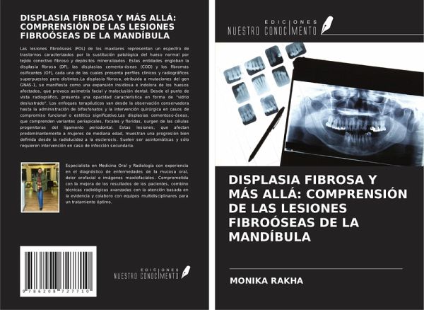 DISPLASIA FIBROSA Y MÁS ALLÁ: COMPRENSIÓN DE LAS LESIONES FIBROÓSEAS DE LA MANDÍBULA