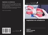 Implantes en ortodoncia