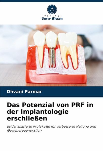 Das Potenzial von PRF in der Implantologie erschließen Das Potenzial von PRF in der Implantologie erschließen