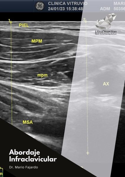 Abordaje Infraclavicular (eBook, ePUB) Abordaje Infraclavicular (eBook, ePUB)