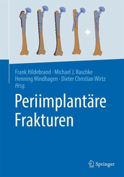 Cover Periimplantäre Frakturen (eBook, PDF)