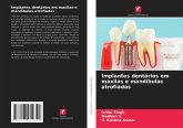 Implantes dentários em maxilas e mandíbulas atrofiadas Implantes dentários em maxilas e mandíbulas atrofiadas