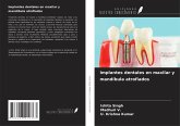 Implantes dentales en maxilar y mandíbula atrofiados Implantes dentales en maxilar y mandíbula atrofiados