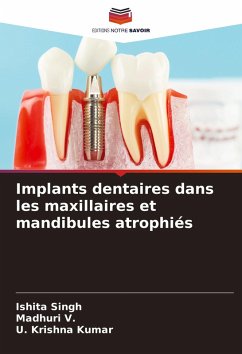Implants dentaires dans les maxillaires et mandibules atrophiés - Singh, Ishita;V., Madhuri;Kumar, U. Krishna