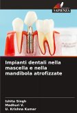 Impianti dentali nella mascella e nella mandibola atrofizzate Impianti dentali nella mascella e nella mandibola atrofizzate