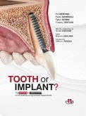 Tooth or Implant? (eBook, ePUB) Tooth or Implant? (eBook, ePUB)