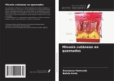 Micosis cutáneas en quemados Micosis cutáneas en quemados