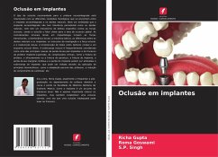 Cover Oclusão em implantes
