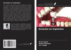 Oclusión en implantes