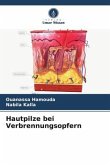 Hautpilze bei Verbrennungsopfern Hautpilze bei Verbrennungsopfern