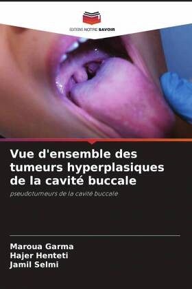 Vue d'ensemble des tumeurs hyperplasiques de la cavité buccale Vue d'ensemble des tumeurs hyperplasiques de la cavité buccale