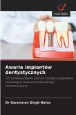 Awarie implantów dentystycznych Awarie implantów dentystycznych