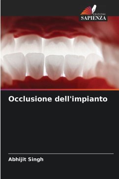 Occlusione dell'impianto - Singh, Abhijit Occlusione dell'impianto - Singh, Abhijit