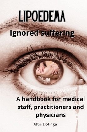 Lipoedema