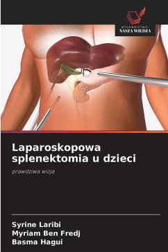 Laparoskopowa splenektomia u dzieci - Laribi, Syrine;Ben Fredj, Myriam;Hagui, Basma Laparoskopowa splenektomia u dzieci - Laribi, Syrine;Ben Fredj, Myriam;Hagui, Basma