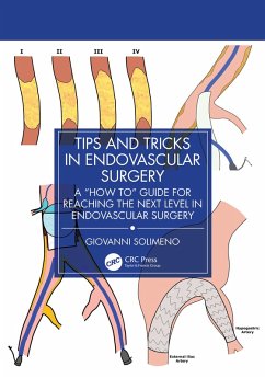 Tips and Tricks in Endovascular Surgery (eBook, ePUB) - Solimeno, Giovanni Tips and Tricks in Endovascular Surgery (eBook, ePUB) - Solimeno, Giovanni